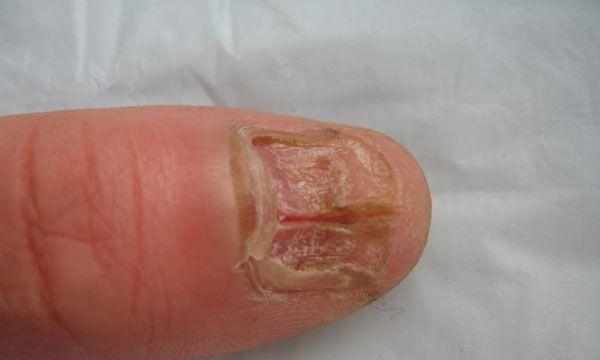 哈士奇易发真菌病的预防与治疗（以宠物为主，如何预防和治疗哈士奇的真菌病）