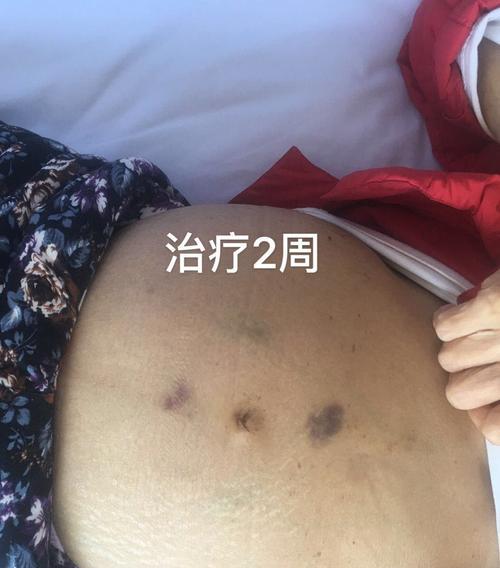 大狗腹水怎么治疗？大狗腹水治疗方法有哪些？