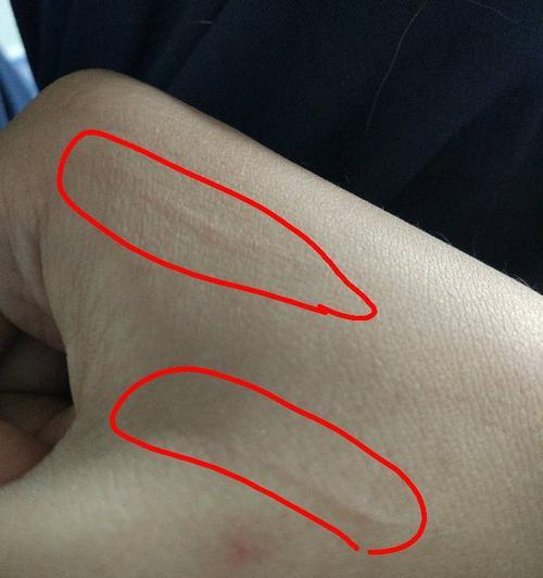被大狗抓破皮了怎么办？如何进行紧急处理和预防感染？