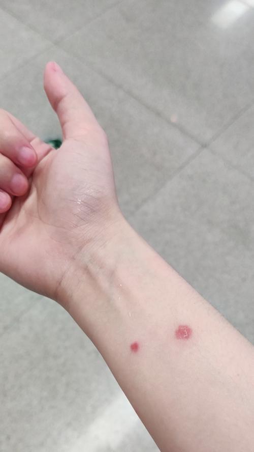 人身上的猫藓——症状及治疗（以宠物为主的常见皮肤问题）