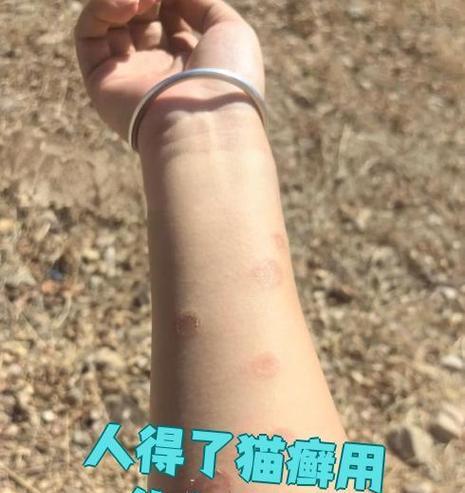 以人得猫藓，是否一定会痒（探究猫藓的传染途径及症状）