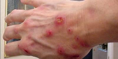 狗被蜱虫咬了会死吗？——揭开狗狗患上蜱病的真相
